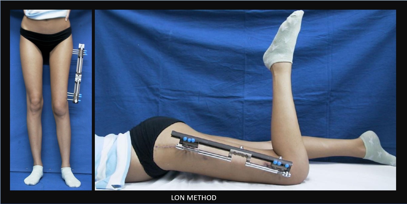 लंबाई बढ़ाने में कितना खर्च होगा? Cost of Limb Lengthening Surgery in India  | Increase your Height - YouTube
